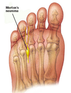 Image taken from: http://www.performpodiatry.co.nz/painful-forefoot-mortons-neuroma-causes-treatment-and-prevention/